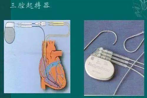 三腔起搏器價(jià)格及壽命解析